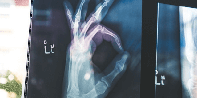 Xray of hand giving an OK gesture