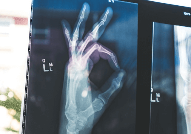 Xray of hand giving an OK gesture